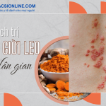 Tổng hợp cách trị bệnh giời leo theo nhân gian được nhiều người áp dụng