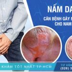 Ngứa Bẹn Và Bìu Ở Nam Giới: Nguyên Nhân Và Phác Đồ Điều Trị