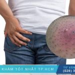 Các Phương Pháp Xét Nghiệm Chẩn Đoán Áp Xe Quanh Hậu Môn