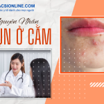 Tìm hiểu nguyên nhân mụn ở cằm để điều trị dứt điểm hiệu quả