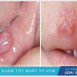 Miệng Bị Nổi Mụn Nước Có Nguy Hiểm Không? Cách Điều Trị Hiệu Quả