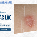Bị hắc lào kiêng gì để bệnh không lan rộng và nhanh khỏi?