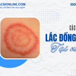 Bạn đã thử những cách trị lác đồng tiền tại nhà hiệu quả chưa?