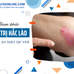 Cách khắc phục hắc lào tại nhà bằng mẹo tự nhiên an toàn