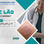 Bị hắc lào có lây không? Những thông tin bạn nên lưu ý