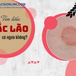 Hắc lào có ngứa không? tìm hiểu dấu hiệu và biện pháp xử lý