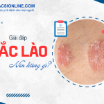 Hắc lào kiêng gì để phục hồi nhanh và tránh tái phát?