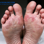 Dấu hiệu khỏi bệnh hắc lào bạn không nên bỏ qua