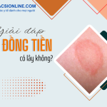 Lác đồng tiền liệu có lây không và hướng dẫn phòng tránh