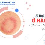 Lác đồng tiền vùng háng: Nguyên nhân và cách điều trị nhanh nhất