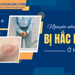 Nguyên nhân bị hắc lào ở háng khiến nhiều người mắc phải