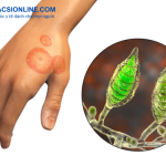 Bị hắc lào có lây không? Tất tần tật kiến thức cần biết