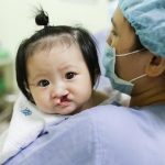 Vén màn những nguyên nhân hở hàm ếch hàng đầu ở trẻ