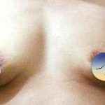 Hỏi đáp nguyên nhân ngực bị chảy xệ là gì