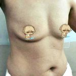 Dứt điểm ngực chảy xệ làm sao đây