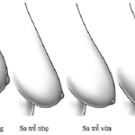 Căng da ngực chảy xệ và những điều cần biết