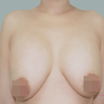 Học hỏi làm thế nào để ngực bớt chảy xệ