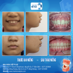 Giá Niềng Răng Cho Trẻ 15 Tuổi: Những Điều Cần Biết