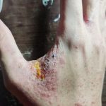 Bệnh ghẻ lây cả nhà chữa bằng cách nào ?