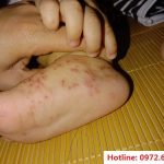 Top 4 bài thuốc đánh bay bệnh ghẻ ở trẻ em hiệu quả