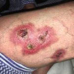 Bệnh viêm da hoại tử có nguy hiểm tới tính mạng không?