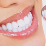 Chuyên gia tư vấn: Bọc răng sứ có bị đen lợi không?