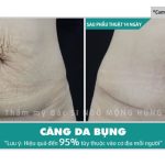 Làm sao để xóa nếp nhăn ở bụng