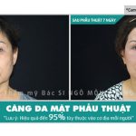 Giá phẫu thuật căng da mặt mới nhất là bao nhiêu