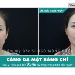Trứng gà làm căng da mặt có hiệu quả không