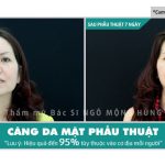 Căng da mặt chảy xệ có hiệu quả không