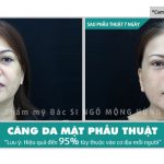 thẩm mỹ căng da mặt ở đâu chất lượng?