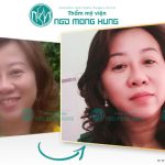 Nên xem clip căng da mặt nội soi ở đâu