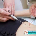 Chi phí chữa sùi mào gà ở TPHCM bao nhiêu?