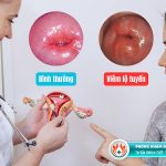 Chi phí đốt viêm lộ tuyến cổ tử cung ở TPHCM là bao nhiêu?