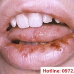 Địa Chỉ Chữa Bệnh Lậu Ở Hà Đông