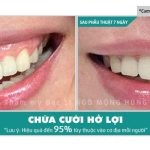 Con trai cười hở lợi thì sao- BV Ngô Mộng Hùng