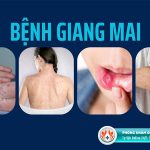 Lưu ngay 8 cách chữa giang mai tại nhà hiệu quả