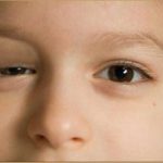 Giảm sụp mí mắt phải làm sao?
