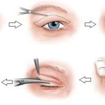 Hình ảnh mắt bị sụp mí| Thẩm mỹ viện Ngô Mộng Hùng