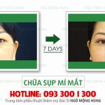 Mách bạn cách hết sụp mí an toàn và hiệu quả