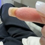 Địa chỉ chữa Tổ Đỉa ở Hà Đông