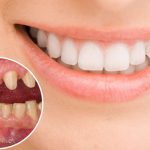 Giải đáp thắc mắc: Có nên bọc răng sứ thẩm mỹ không?