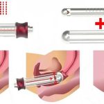 May thẩm mỹ tầng sinh môn có đau không