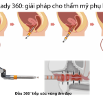 Giá thẩm mỹ tầng sinh môn