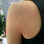 Dấu hiệu dị ứng nổi mề đay toàn thân