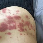 Dị Ứng Thời Tiết Kiêng Gì ?