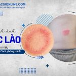 Nhận diện hắc lào qua hình ảnh và cách chữa hiệu quả