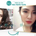 gọt mặt có đau không- BV Ngô Mộng Hùng