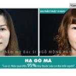 hạ gò má hết bao nhiêu tiền- BV Ngô Mộng Hùng