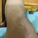 Hình ảnh bệnh ghẻ ngứa